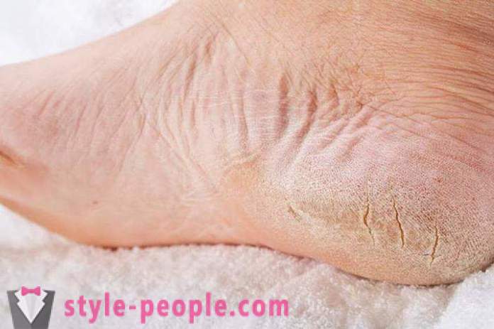 Kuiv nahk, jalad: põhjused